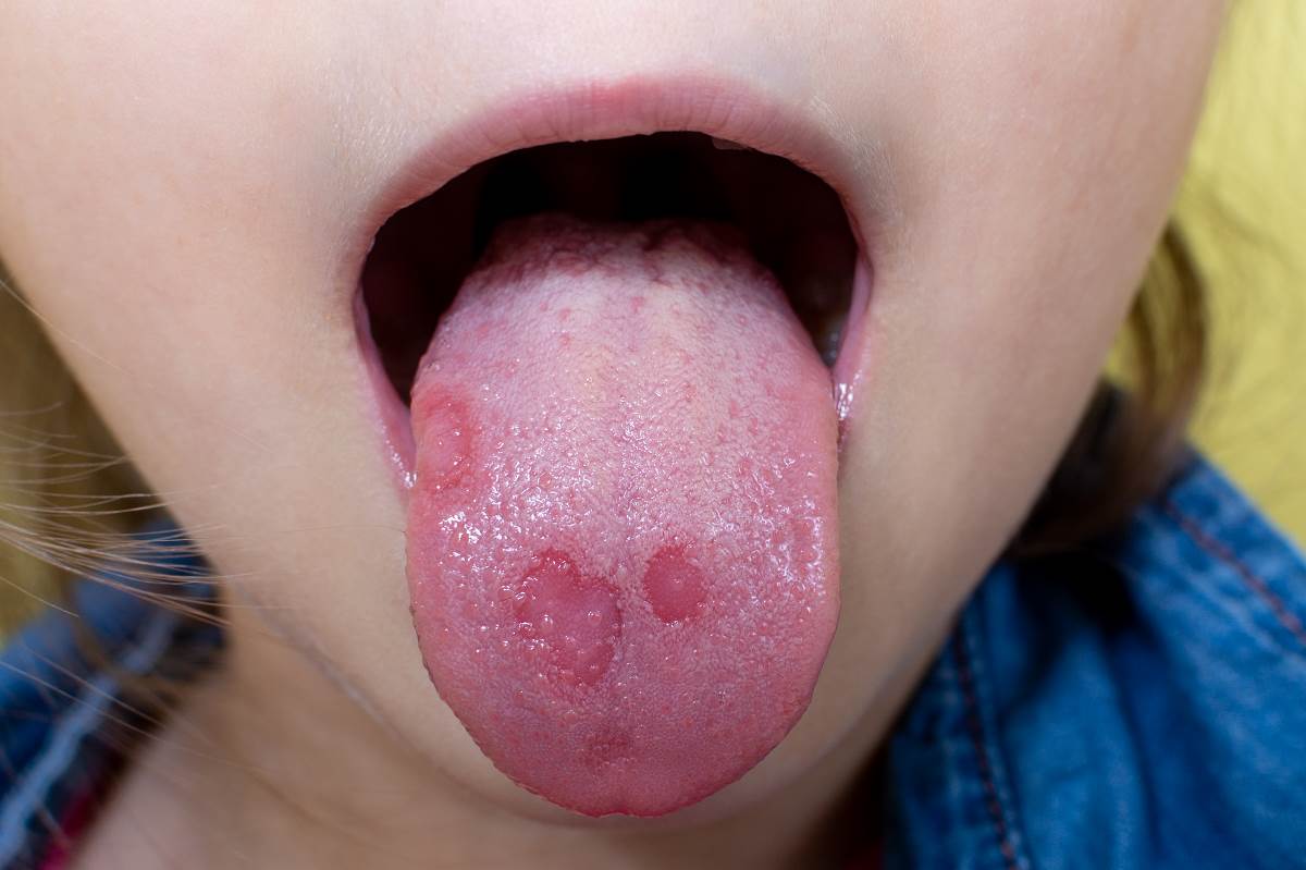kisele lizalice izazivaju opekotine na jeziku