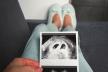 Trudnoća, blizanci, ultrazvuk