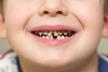 Cirkularni karijes, deca, zubi, pokvareni zubi