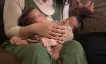 Sijamske bliznakinje