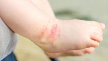 Ekcem, atopijski dermatitis