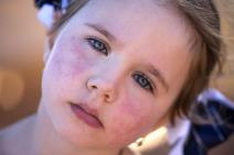 Peta bolest kod dece.