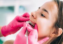 Koliko košta fiksna proteza.