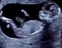 Video beba štuca u maminom stomaku.