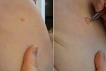 trik za utvrđivanje da li se osip širi.jpg