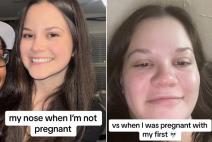 ženi se uvećao nos u trudnoći.jpg