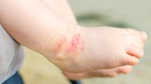 atopijski dermatitis kod dece.jpg