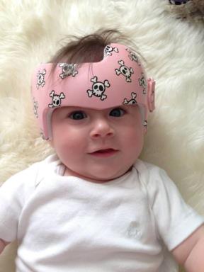 zabavne-igracke-ili-korektivne-kacige-za-bebe-foto
