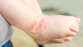 atopijski dermatitis kod dece.jpg