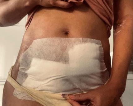 uradili su mi carski rez u 13. nedelji