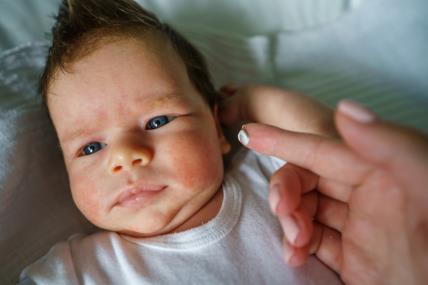 Atopijski dermatitis kod bebe