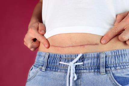 Carski rez, ožiljak