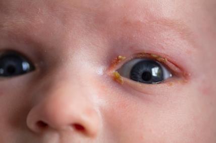 Oči, beba, infekcija, čišćenje