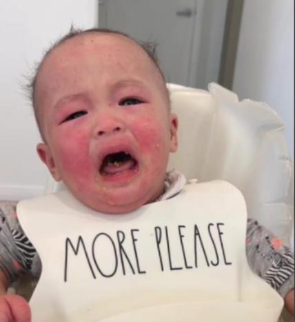 Beba sa alergijom na mleko