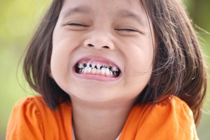 Cirkularni karijes, deca, zubi, pokvareni zubi