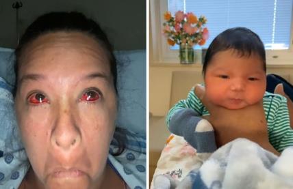 Beba porođaj popucali kapilari.jpg