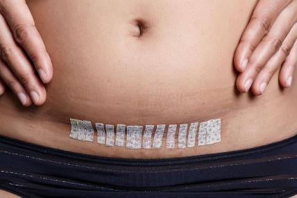 6 rečenica ne smete da kažete mami koja se porodila carskim rezom.