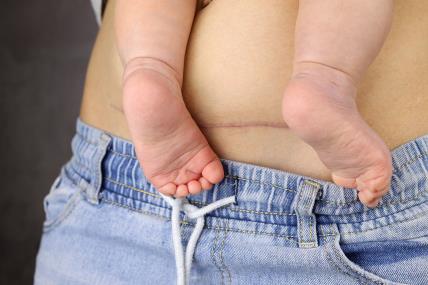 8 stvari koje bih volela da sam znala o carskom rezu.