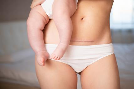 kako se brže oporaviti posle carskog reza.jpg