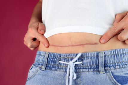 priraslice posle carskog reza.jpg