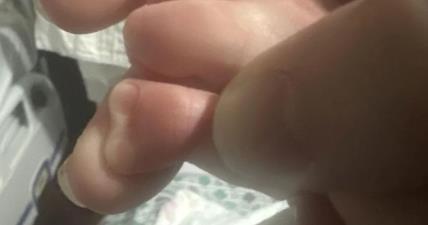 Beba rođena sa palcem u obliku srca.