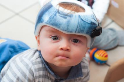 Zašto neke bebe nose šlemove