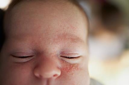 zašto novorođenče ima akne na licu.jpg
