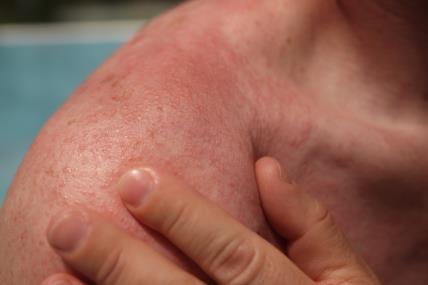 simptomi i vrste alergije na sunce.jpg
