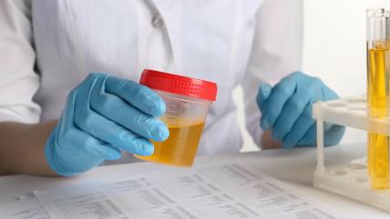 povećan nivo proteina u urinu u trudnoći.jpg