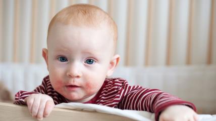 Atopijski dermatitis ili ekcem najčešći kožni problem kod dece