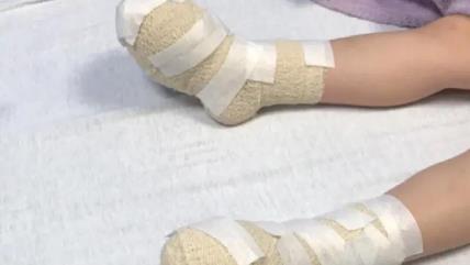 Dete izgorelo stopala na vrelom pesku