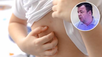 Pojavila se šuga u vrtiću u Beogradu