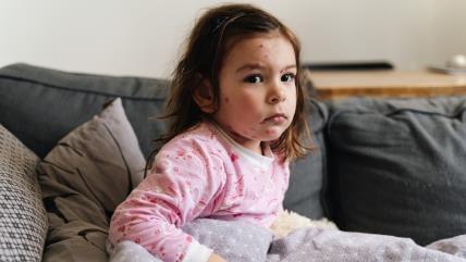 Simptomi malih boginja pre osipa