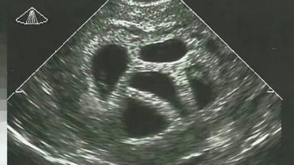 Majka objavila sliku petorki koje su joj savetovali da abortira