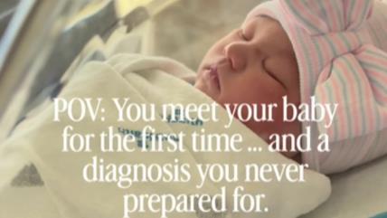 Beba sa Daunovim sindromom