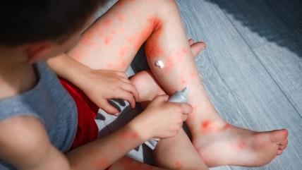 Dečak sa atopijskim dermatitisom