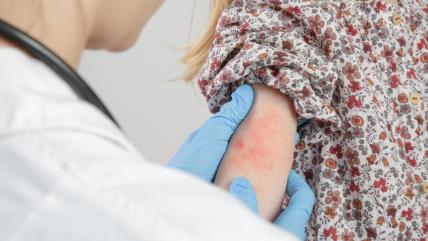 Doktorka pregleda kožu devojčice sa ekcemom