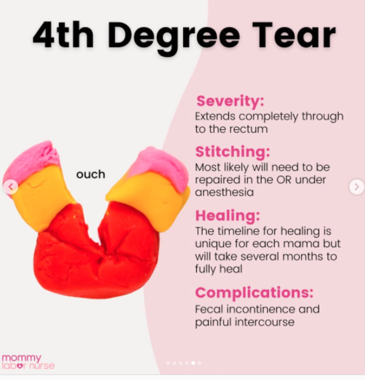 Cepanje prilikom porođaja