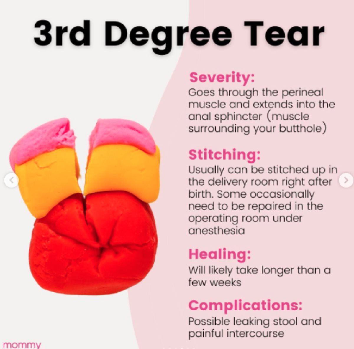 Cepanje prilikom porođaja