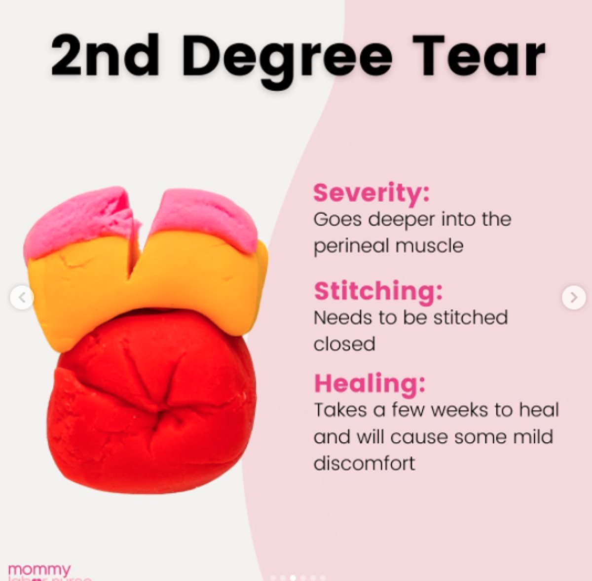 Cepanje prilikom porođaja