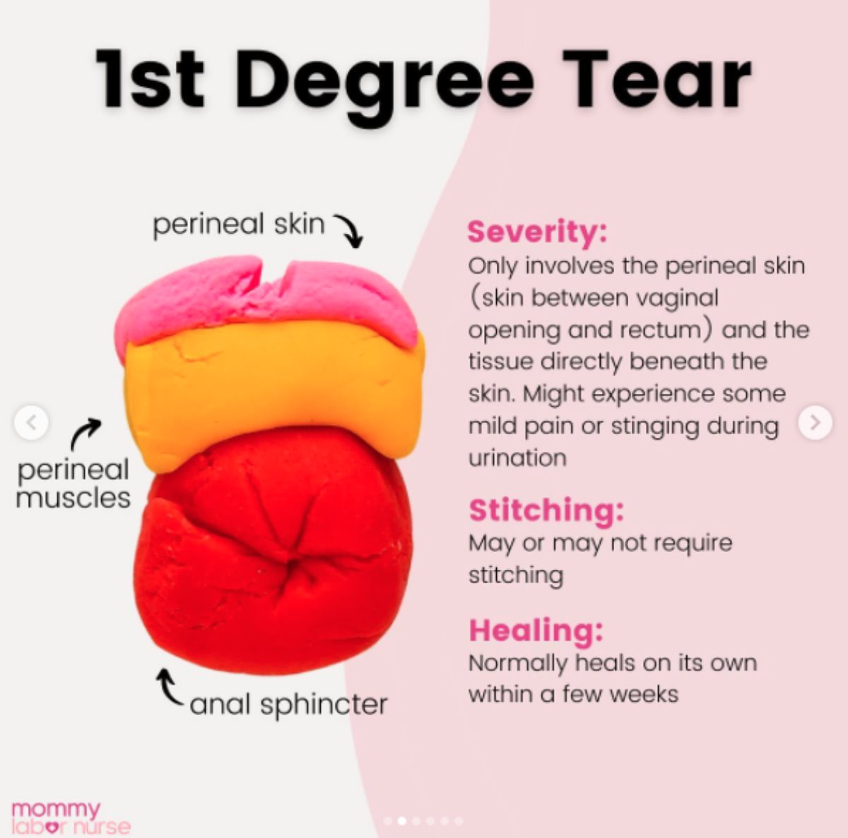 Cepanje prilikom porođaja