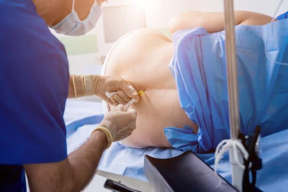 Anestezija, porođaj, spinalna anestezija, epidural