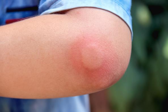 Šta raditi ako dete ubode pčela ili osa