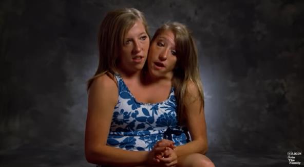 Sijamske bliznakinje postale majke