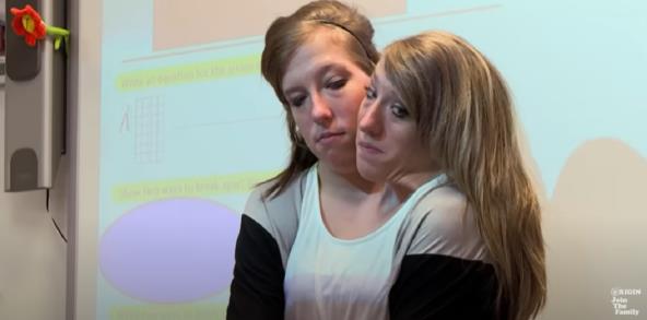 Sijamske bliznakinje postale majke