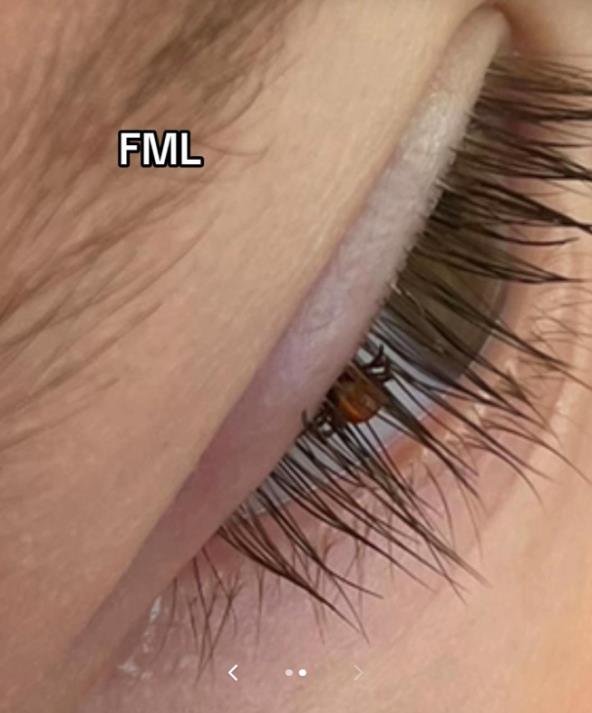 Bebi se krpelj zakačio na trepavice