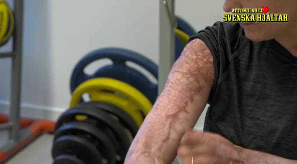 Ožiljci na ruci majke koja je spasla decu iz požara