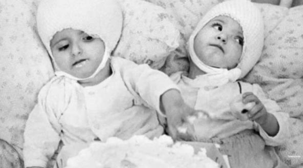 Sijamske bliznakinje nakon operacije razdvajanja