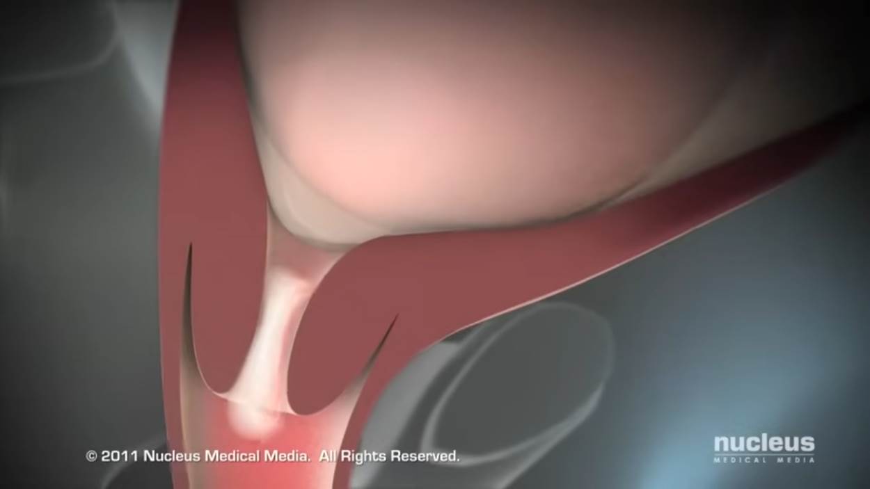 Nucleus Medical Media - Patient Education Animation Labor and Vaginal Birth [ZDP_ewMDxCo - 1250x703 - 0m35s].png