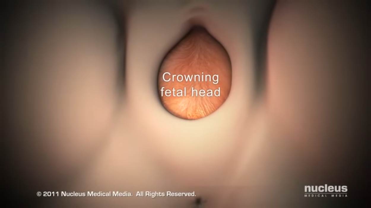 Nucleus Medical Media - Patient Education Animation Labor and Vaginal Birth [ZDP_ewMDxCo - 1250x703 - 1m36s].png